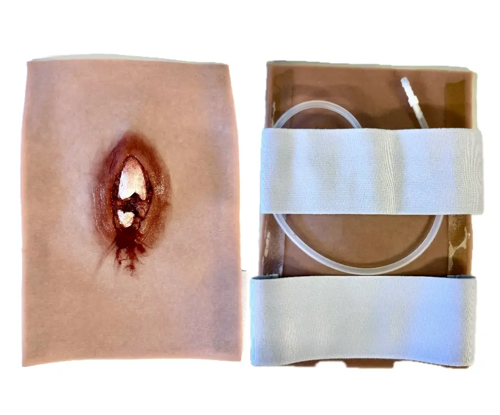 SRP Sårmarkörskada öppen Lårbensfraktur