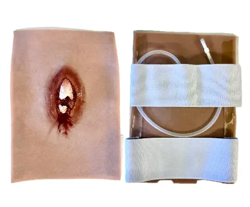 SRP Sårmarkörskada öppen Lårbensfraktur